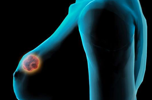 Dissecção Completa ou Observação para Metástases de Linfonodo Sentinela no Melanoma